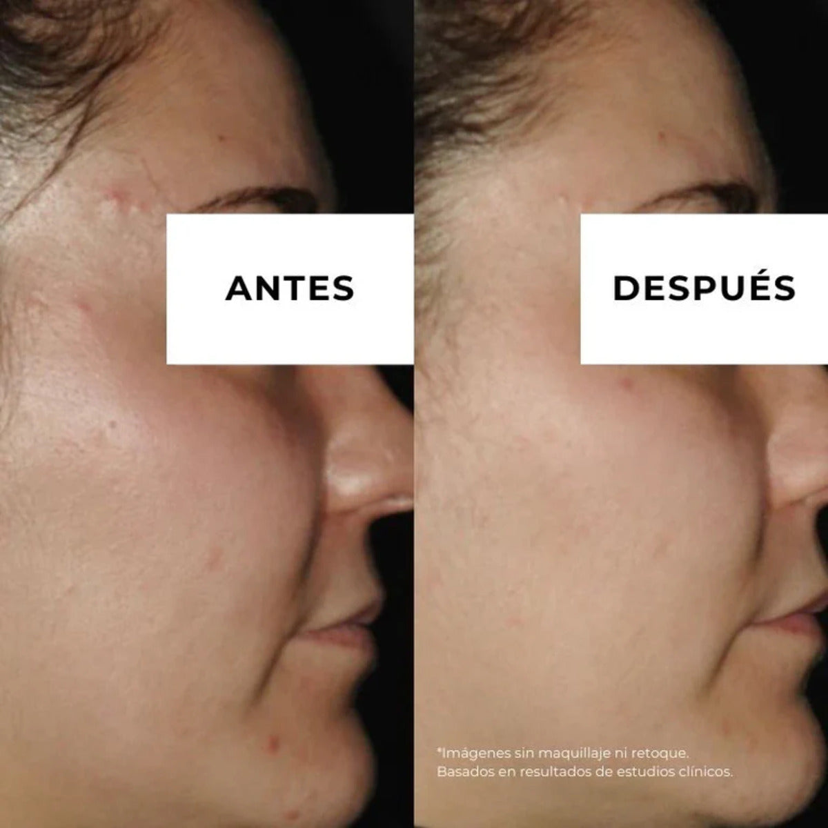 Creme anti-acne Equilibrium para pele oleosa 30ml Arganour