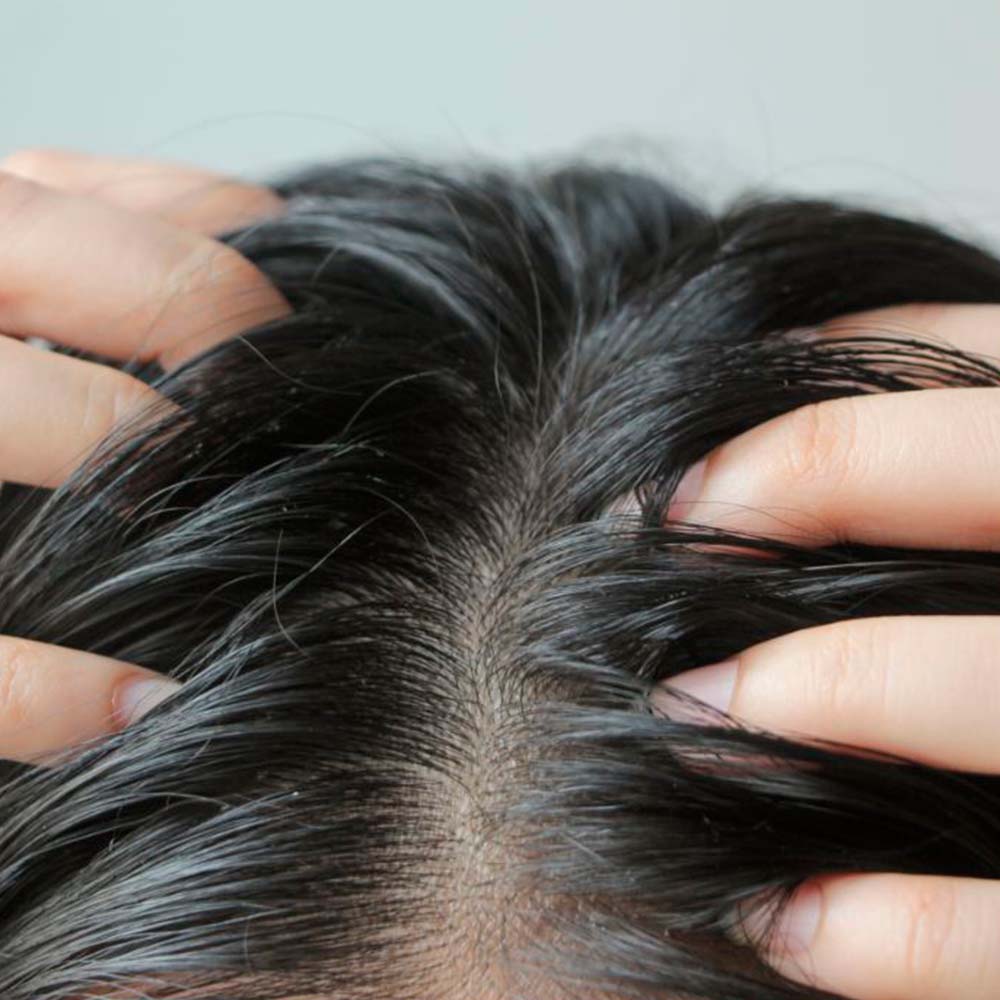 Champú Sólido Anticaspa - 100% Natural - Con Brea - Elimina Caspa Y Alivia Los Picores. Hecho En España - 1ud_2