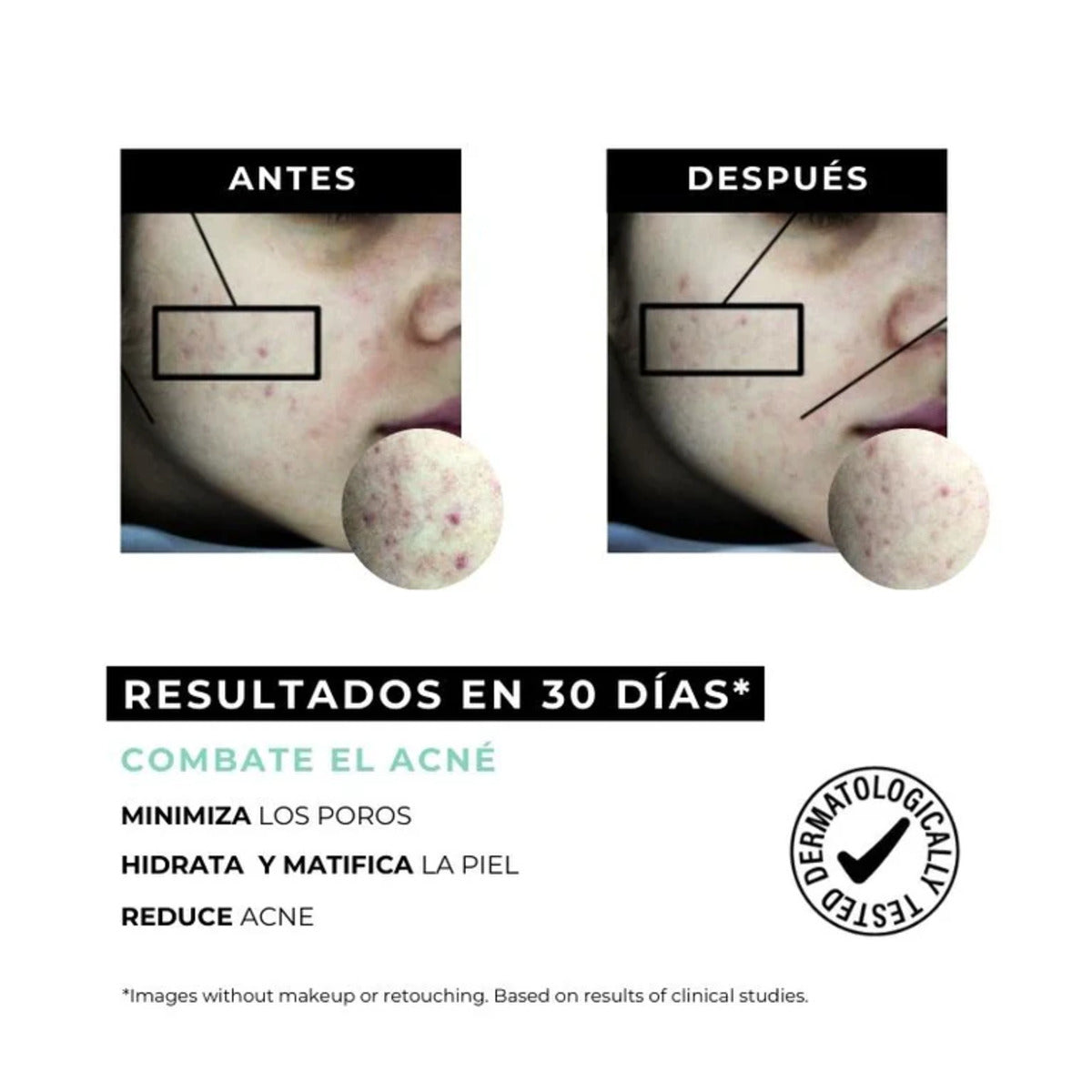 Creme anti-acne Equilibrium para pele oleosa 30ml Arganour