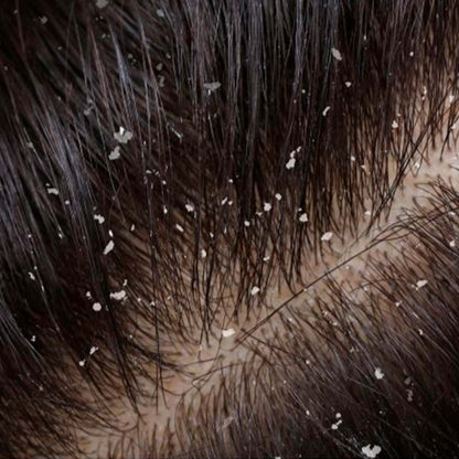 Pack 4 Champú Sólido Anticaspa - 100% Natural - Con Brea - Elimina Caspa Y Alivia Los Picores. Hecho En España_2