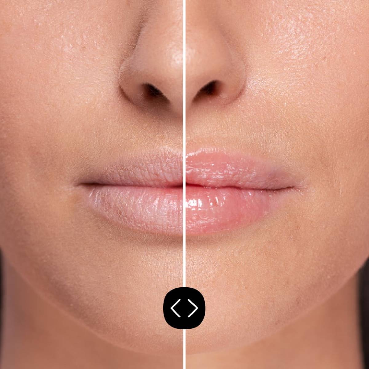 Pack de 2 preenchedores labiais Freshly Hyaluronic de 5ml