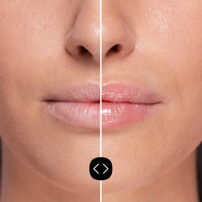 Pack de 2 preenchedores labiais Freshly Hyaluronic de 5ml