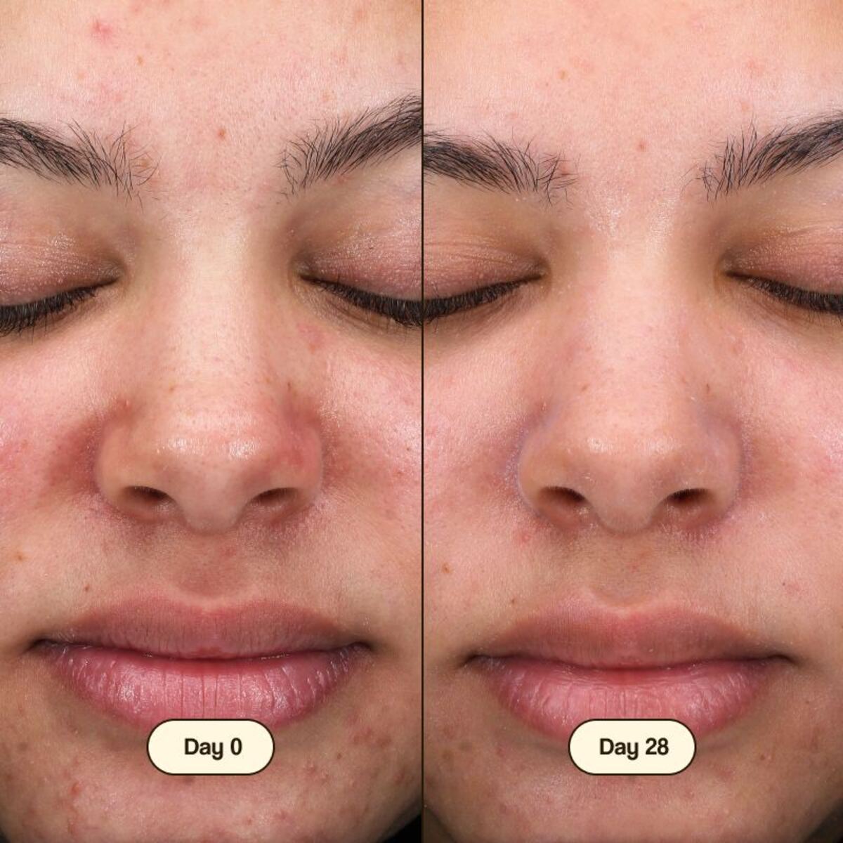 Limpador Facial Salicílico Fresly 100ml